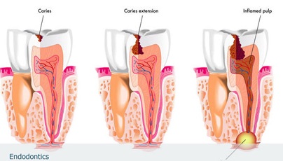 ENDODONTİ