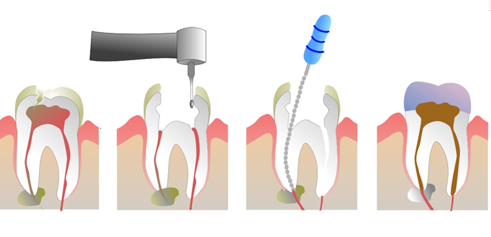 endodont